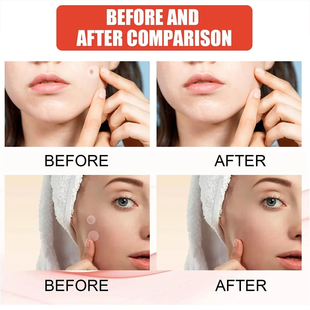 ClearSkin Rapid Invisible Spot Patches